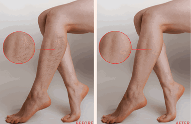 Veingogh Before And After Min